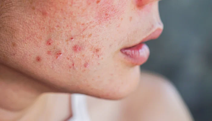 dermatologist kolkata treatment acne