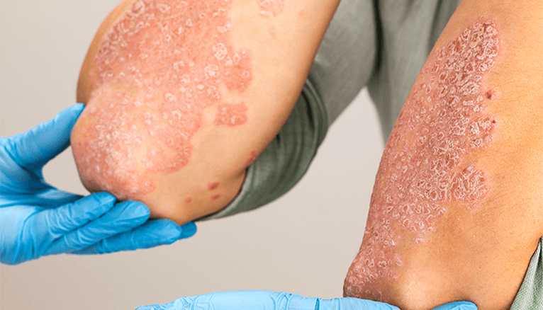 Navigating Psoriasis: From Diagnosis to Treatment